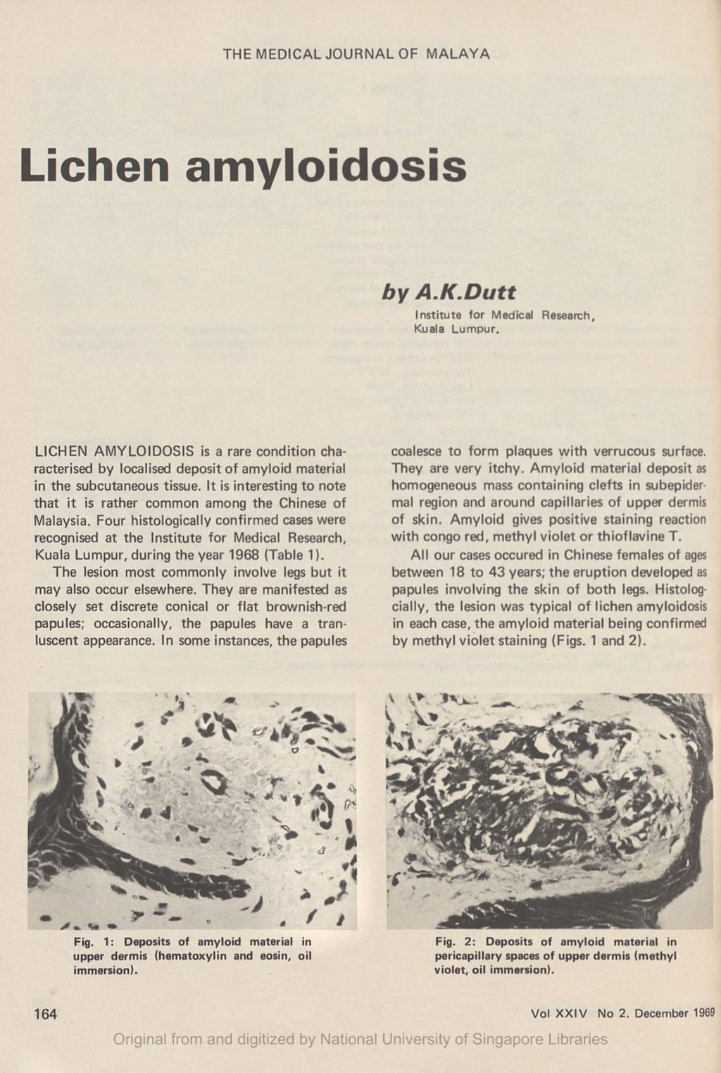 Miniature of Lichen amyloidosis