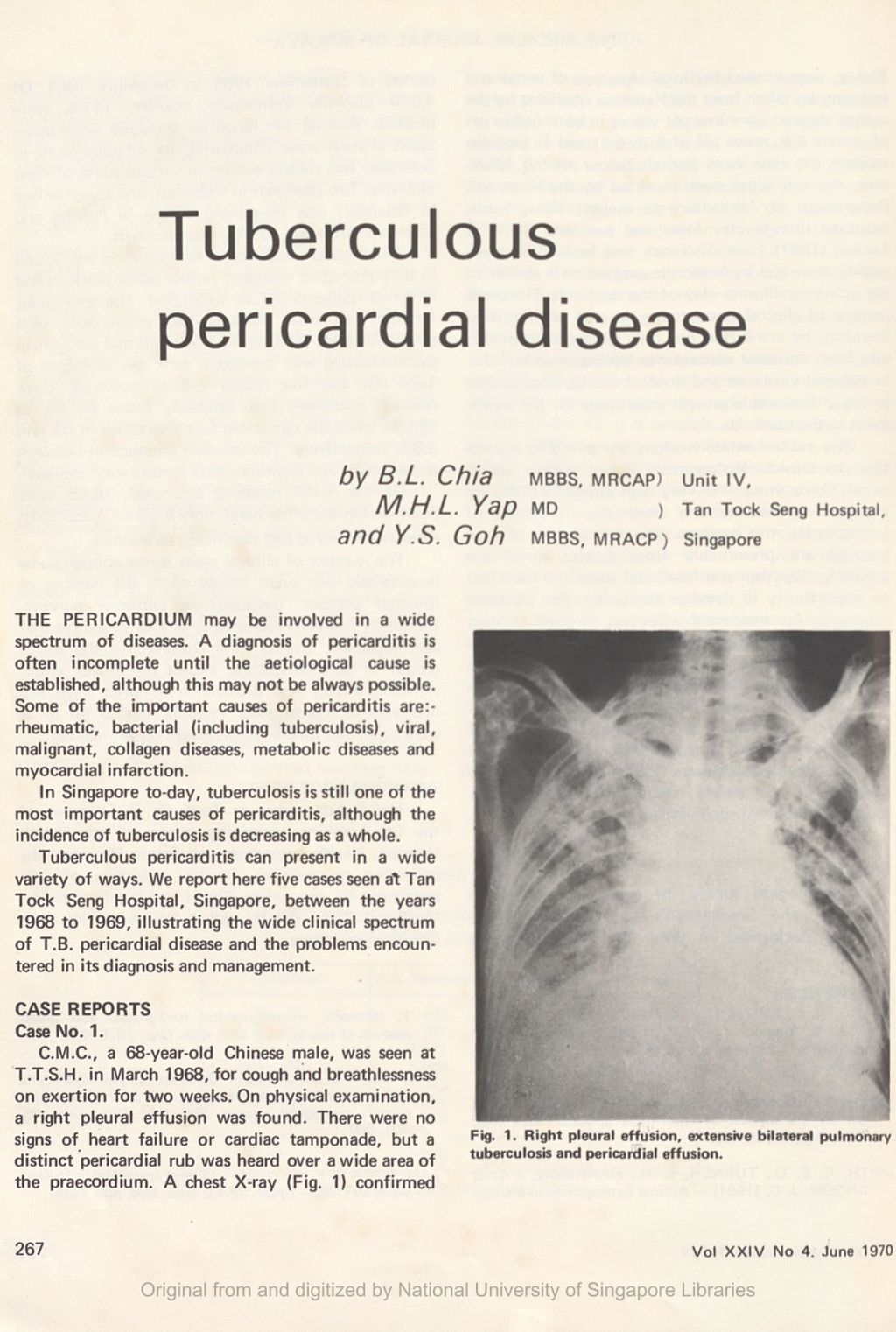 Miniature of Tuberculous pericardial disease