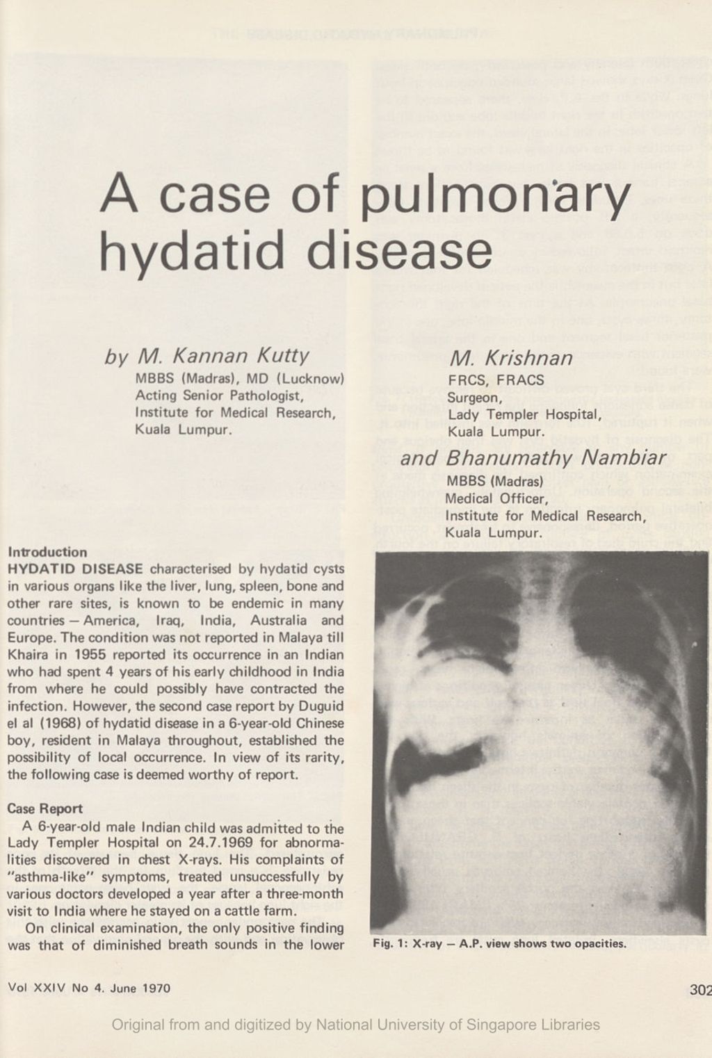 Miniature of Case of pulmonary hydatid disease