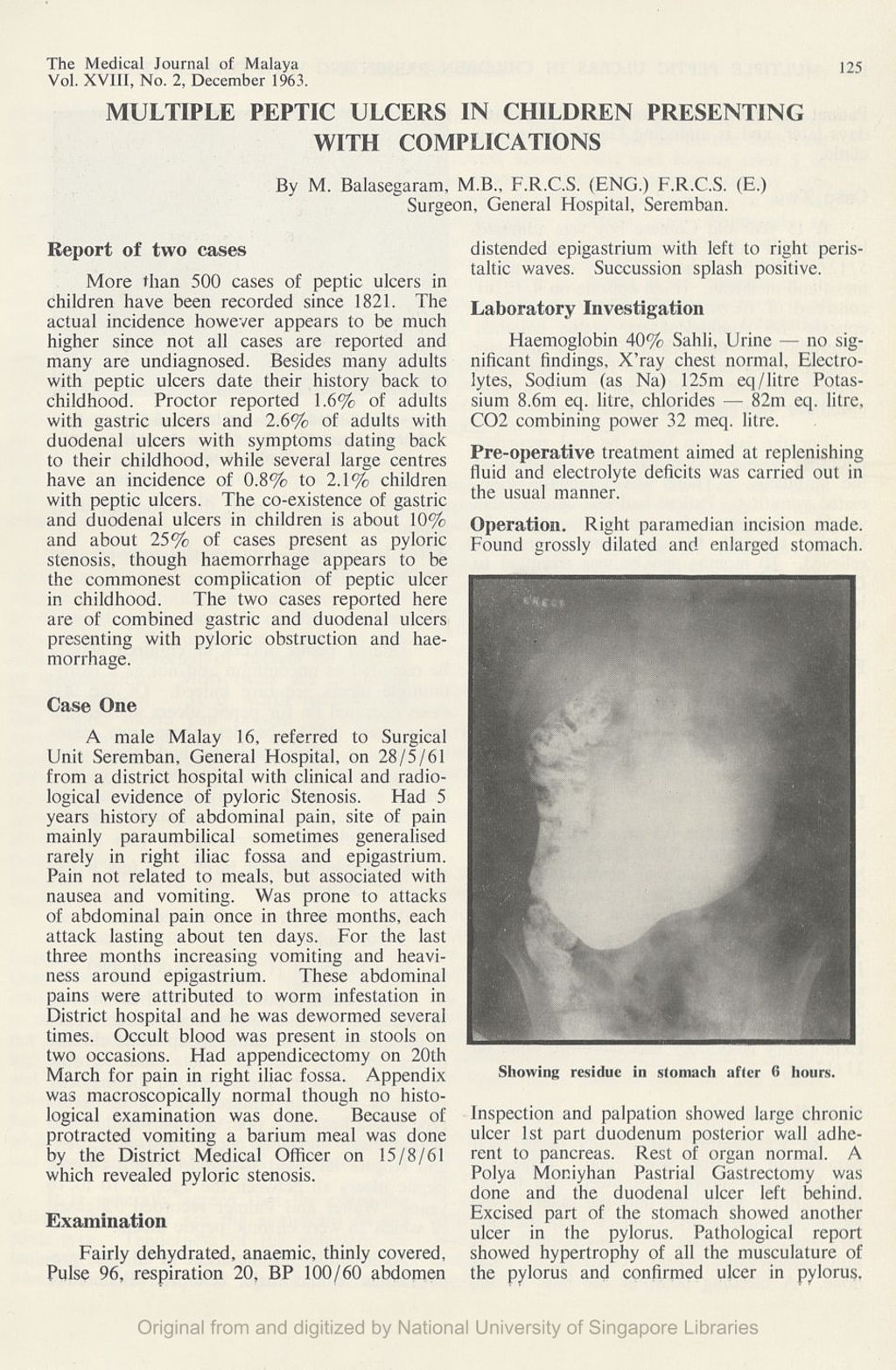 Miniature of Multiple Peptic Ulcers In Children Presenting With Complications