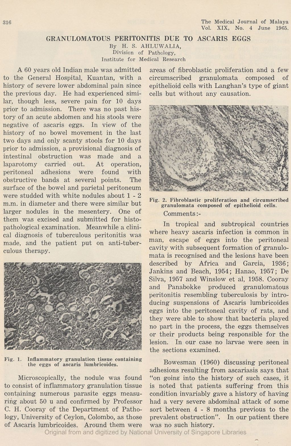 Miniature of Granulomatous Peritonitis Due To Ascaris Eggs