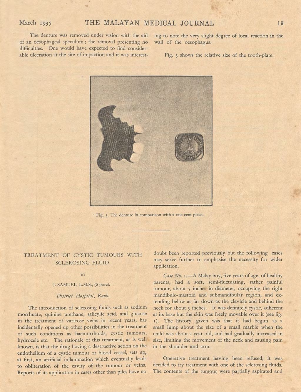 Miniature of Treatment of Cystic Tumours with Sclerosing Fluid