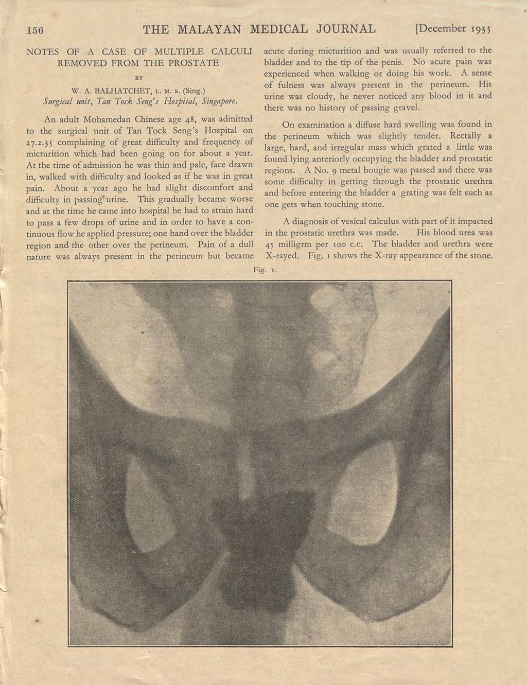 Miniature of Notes of a Case of Multiple Calculi Removed from the Prostate